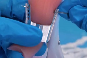 運動員們的跟腱都是怎么修復的？這么看起來真的太辛苦了